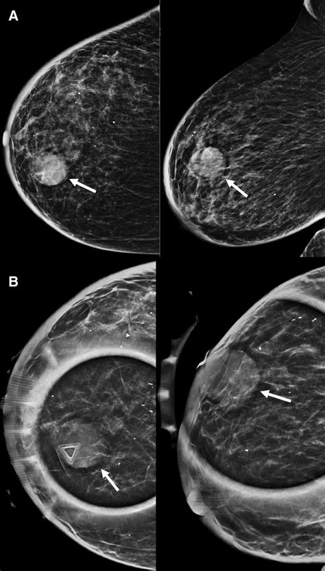 what is spot compression tomosynthesis